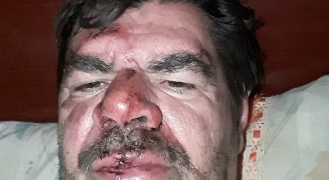 Blogueiro João Moacir sofre acidente de moto