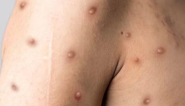 Brasil já é o 3º país com mais casos de varíola dos macacos do mundo