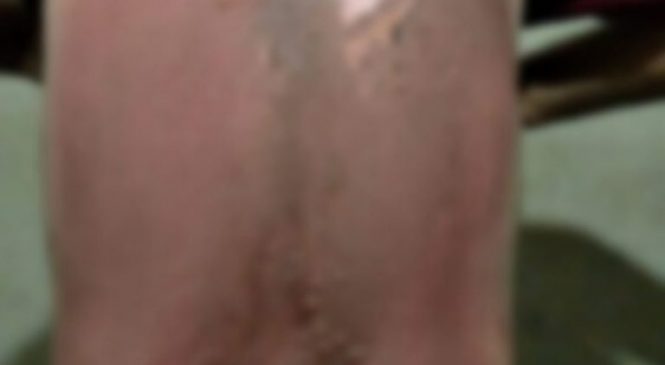 Filha é suspeita de queimar pai com água quente na cidade de Cel. João Pessoa